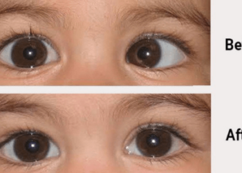 Exploring Non-Surgical Solutions for Squint Treatment