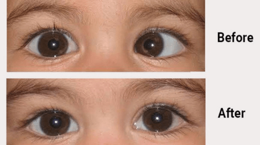 Exploring Non-Surgical Solutions for Squint Treatment