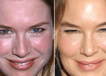 Renee Zellweger Plastic Surgery - A Comprehensive Overview