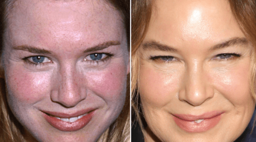 Renee Zellweger Plastic Surgery - A Comprehensive Overview