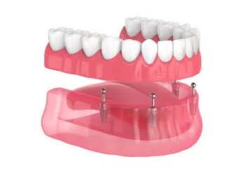 interim dentures yakima