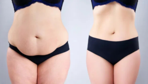 mommy makeover Surgeon in bangalore